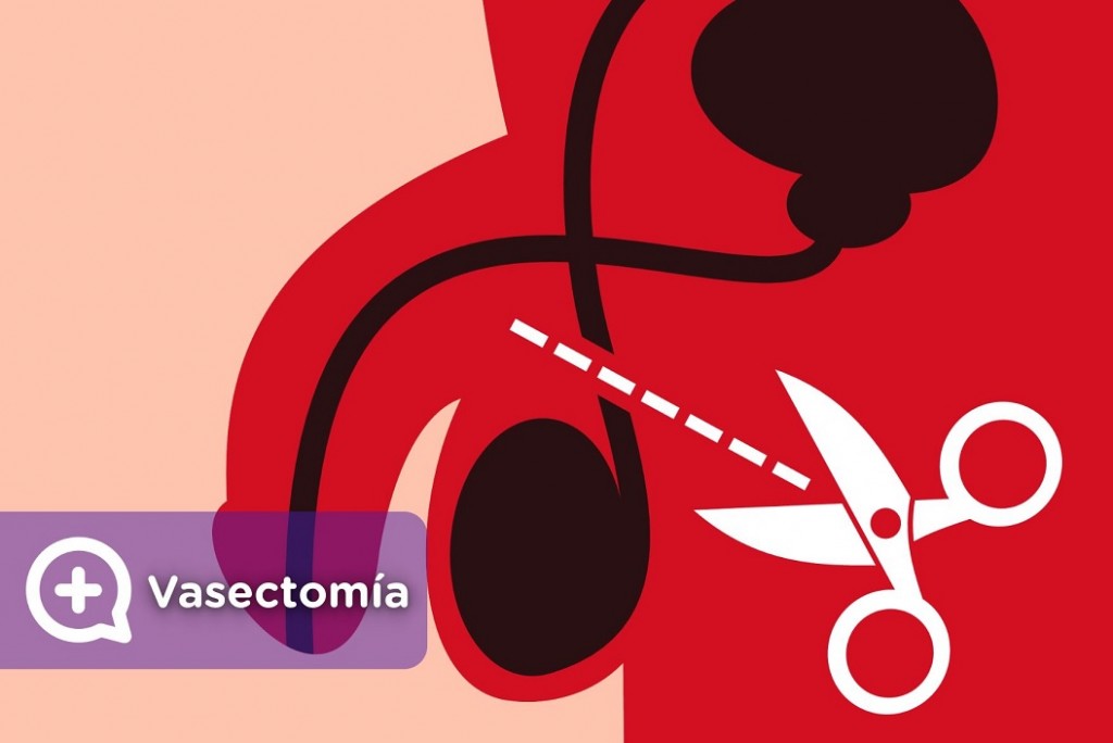 El acceso a la vasectomía garantizado en Catamarca